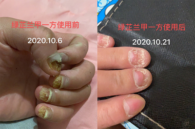 灰指甲用绿芷兰甲一方15天效果
