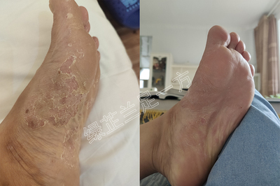 脚脱皮绿芷兰足一方使用效果