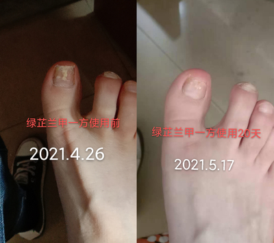 灰指甲使用绿芷兰甲一方20天效果