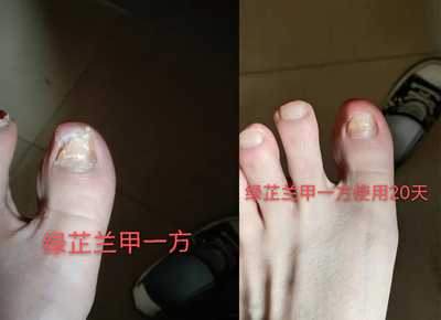 灰指甲使用绿芷兰甲一方20天效果2