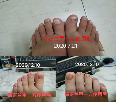 灰指甲发白浑浊用绿芷兰甲一方效果