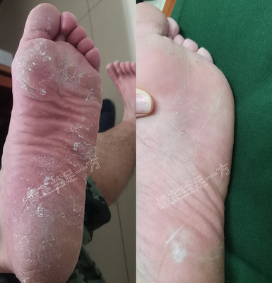 脚脱皮严重绿芷兰足一方效果