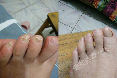 灰指甲增厚发黄用绿芷兰甲一方效果