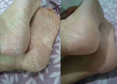 角化型脚气