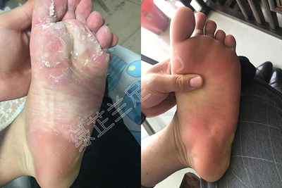 脚脱皮严重