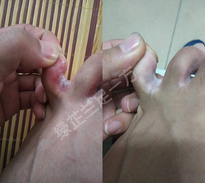 脚趾缝 糜烂+水泡