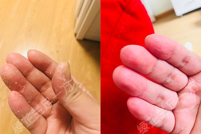 手癣 手脱皮 手痒